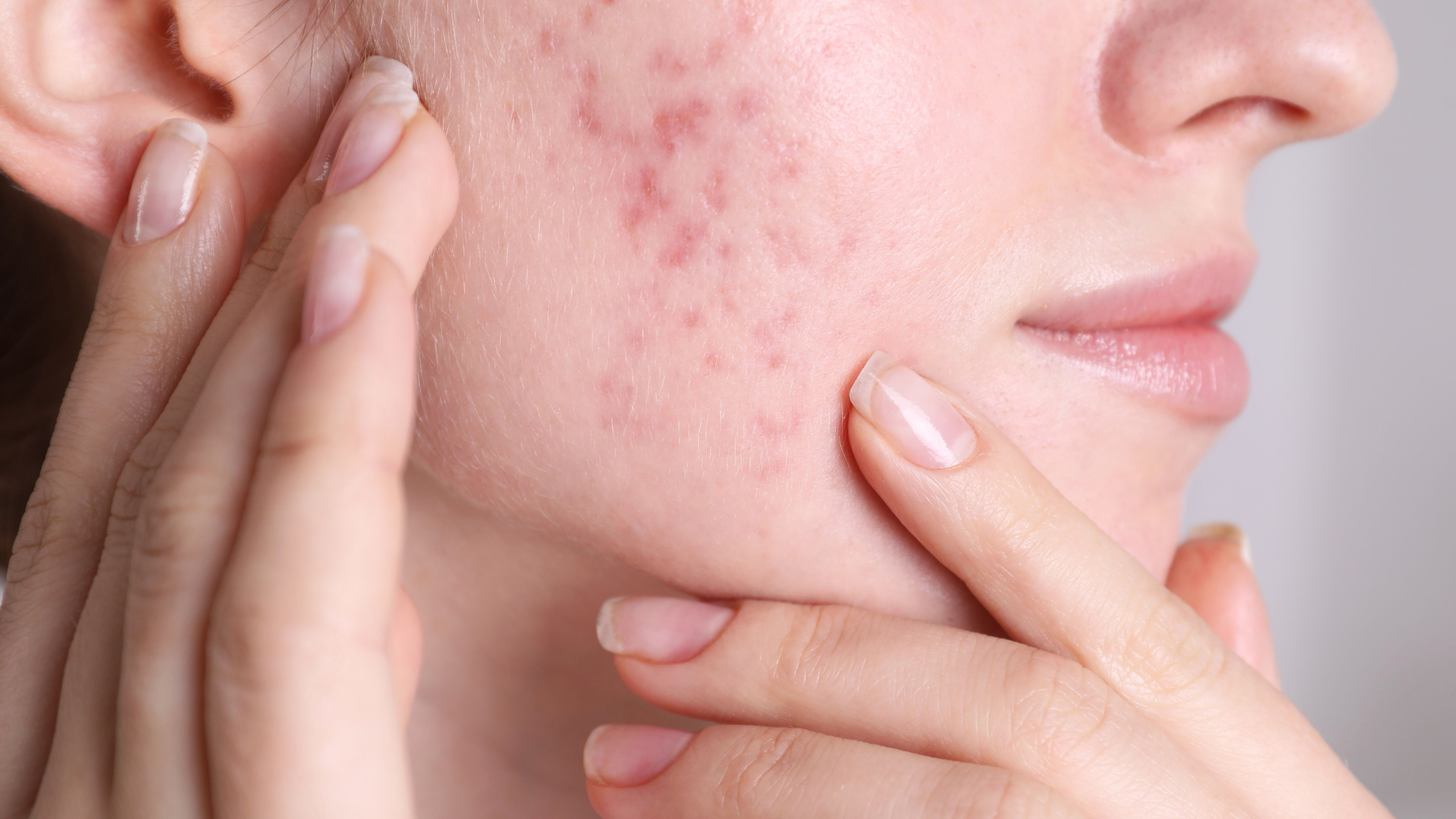Mineral Makeup for Acne-Prone Skin: A Guide to Clearer, Healthier Skin