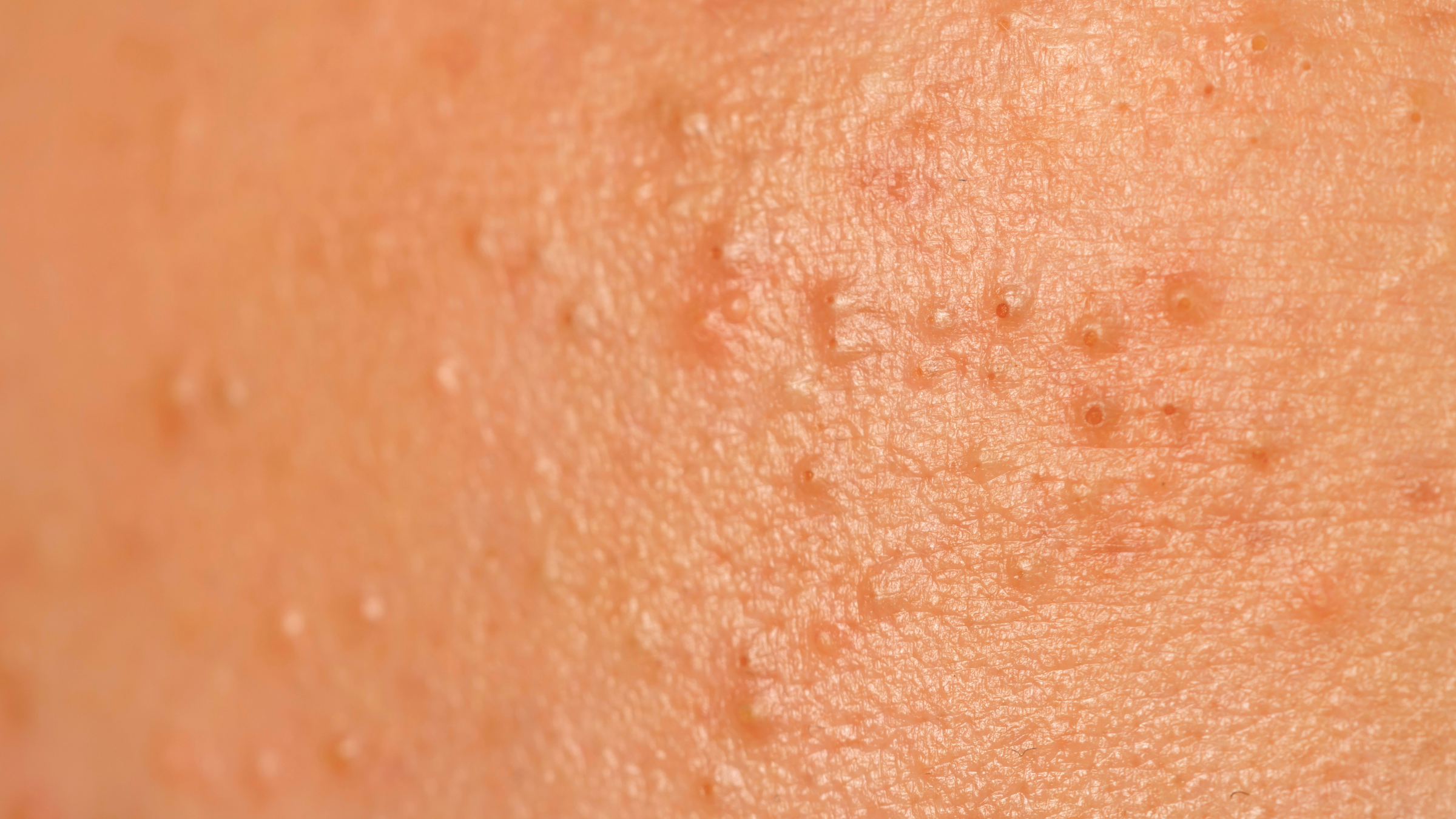 Is Bismuth Oxychloride Clogging Your Pores?