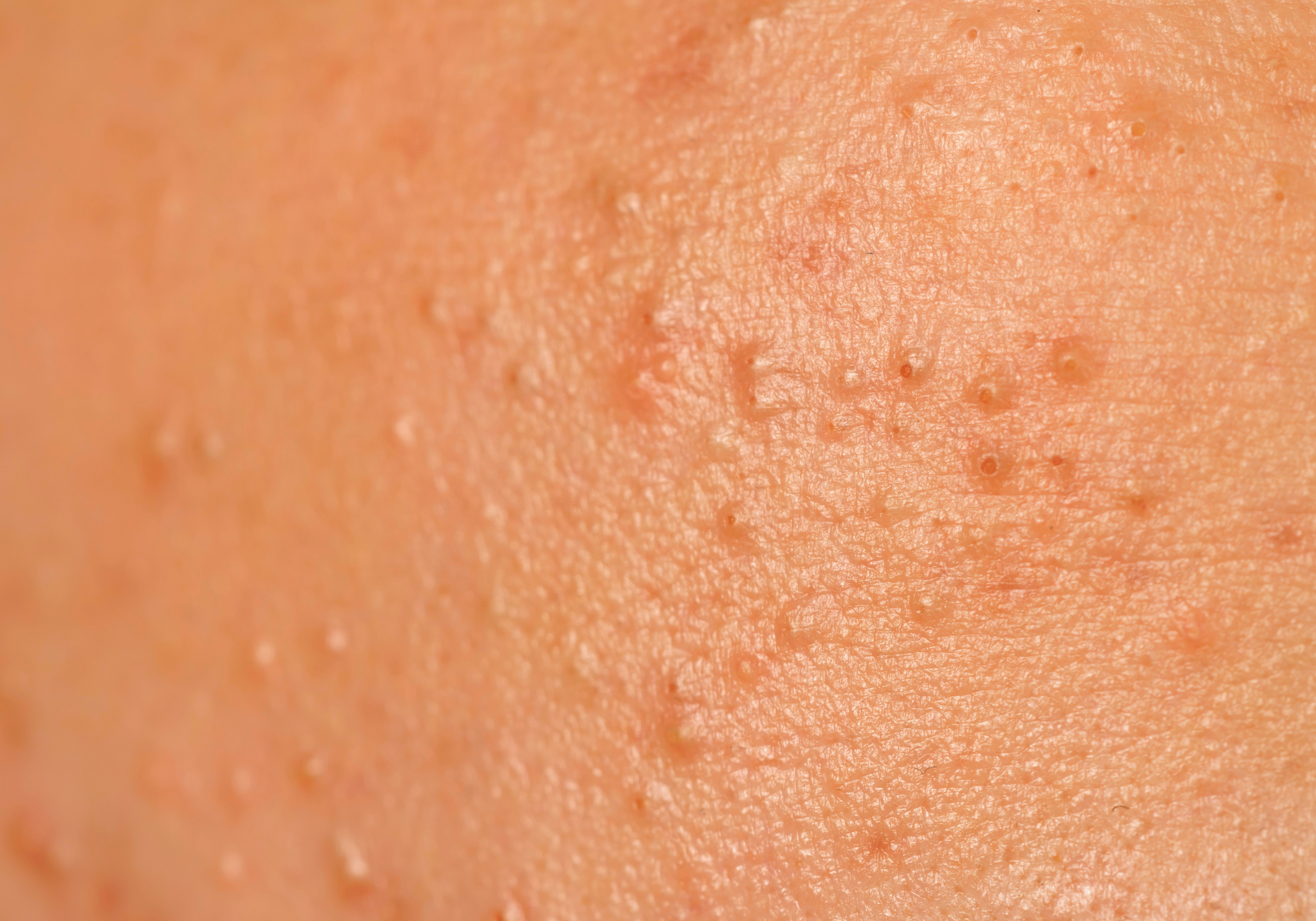 Is Bismuth Oxychloride Clogging Your Pores?