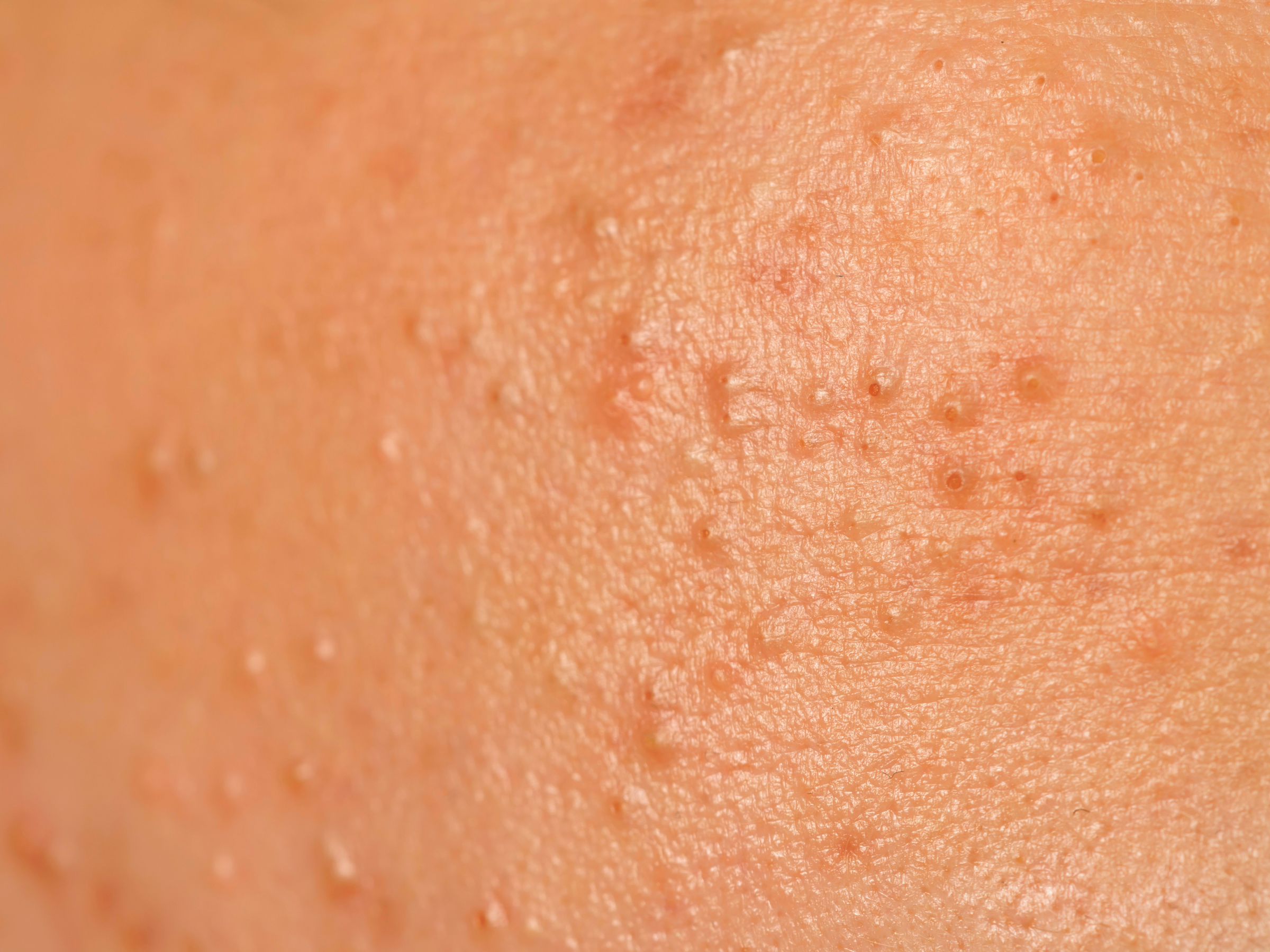 Is Bismuth Oxychloride Clogging Your Pores?