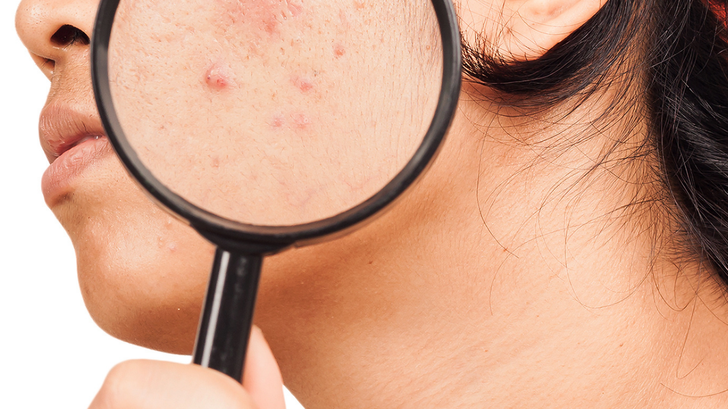 The Link Between Silicone and Acne