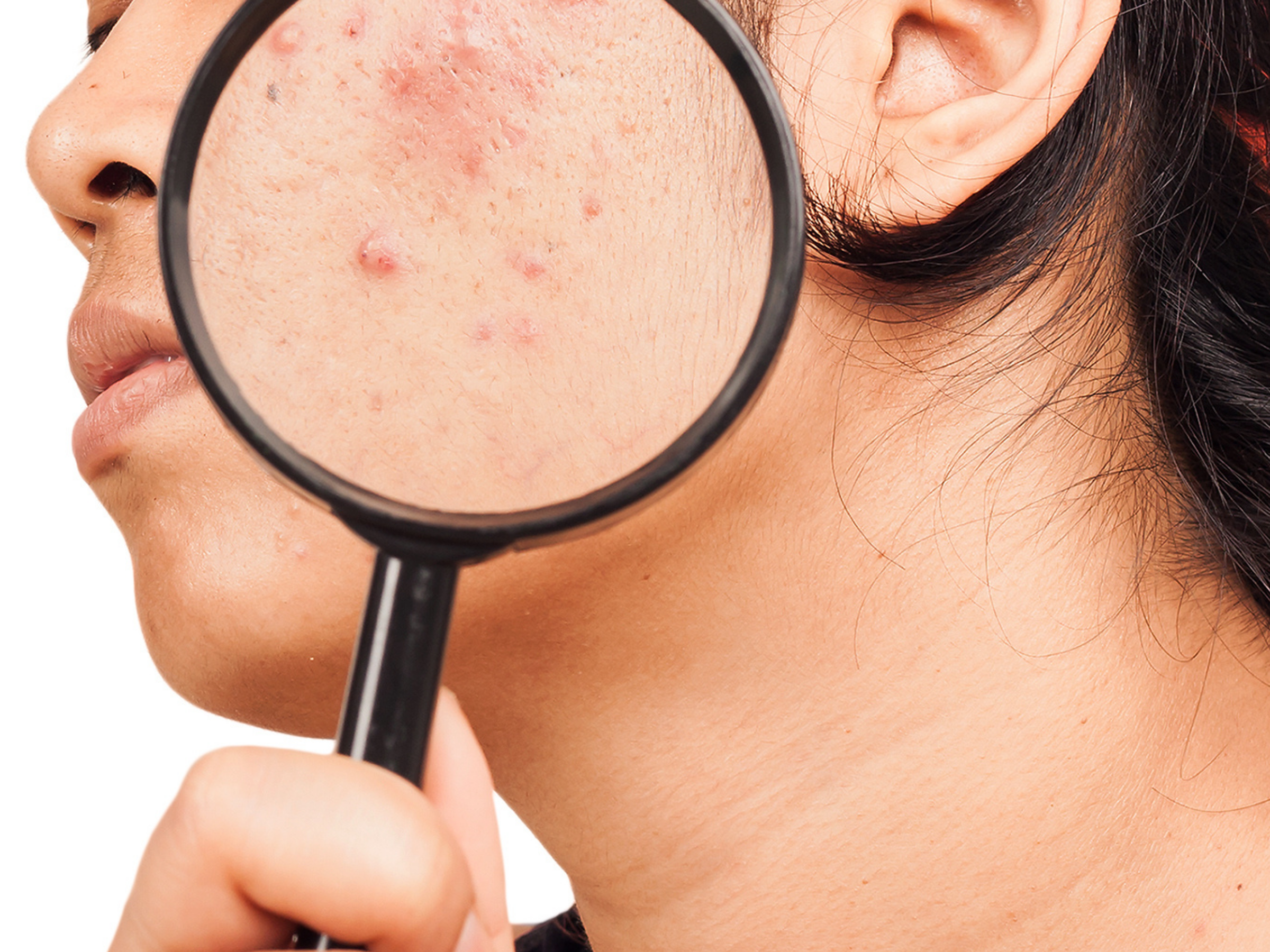 The Link Between Silicone and Acne